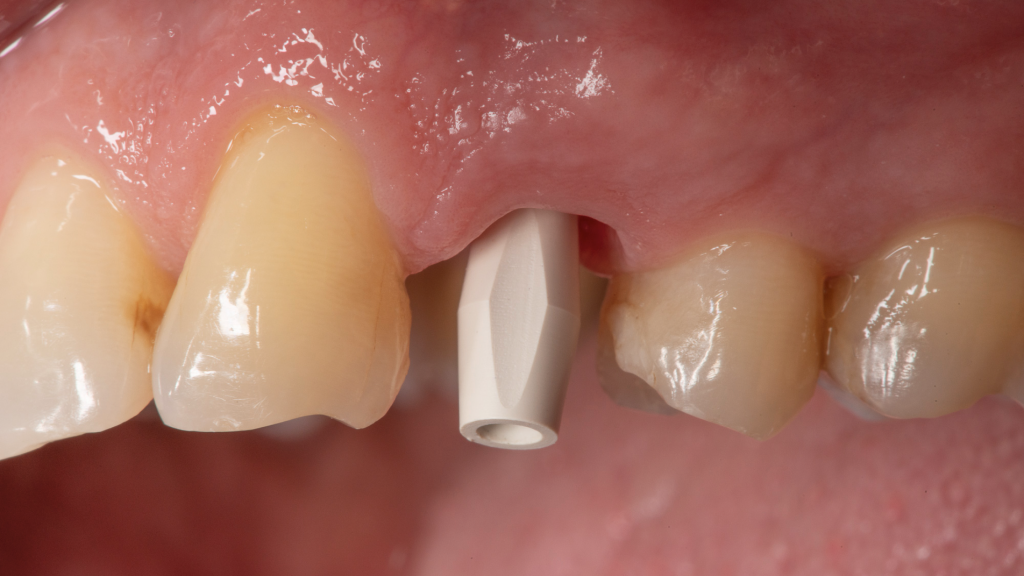 Intraoral scanner capturing an implant scan body seated on a dental arch