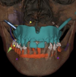 Digital implant planning workflow combining CBCT and intraoral scan data